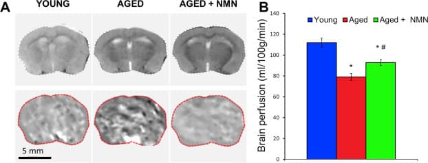 Nmn For Brain Health: Can It Prevent Neurodegenerative Diseases? 4 Nmn For Brain Health: Can It Prevent Neurodegenerative Diseases?